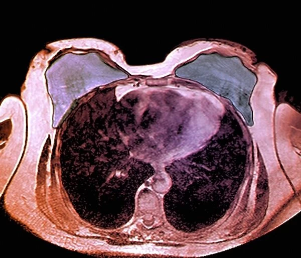 Double mastectomy breast implants, MRI