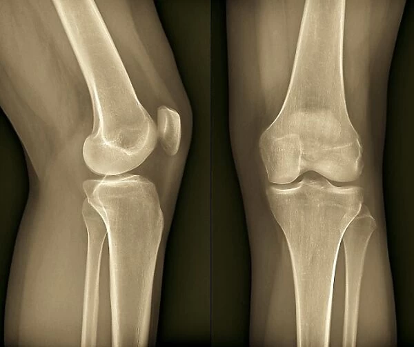 Healthy knee, X-ray F006  /  9125