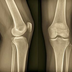 Healthy knee, X-ray F006 / 9125