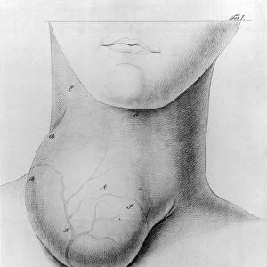 Illustration of man with a large goiter on his neck. Lithograph, 1822